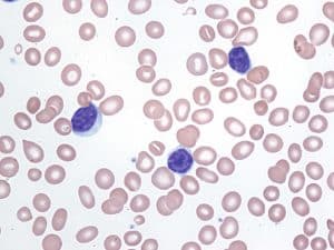 Chronic_lymphocytic_leukemia_(Wright-Giemsa,_50x).