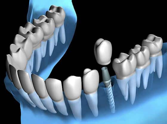 implant-dentaire-definition-schema-vis-pilier-prothese
